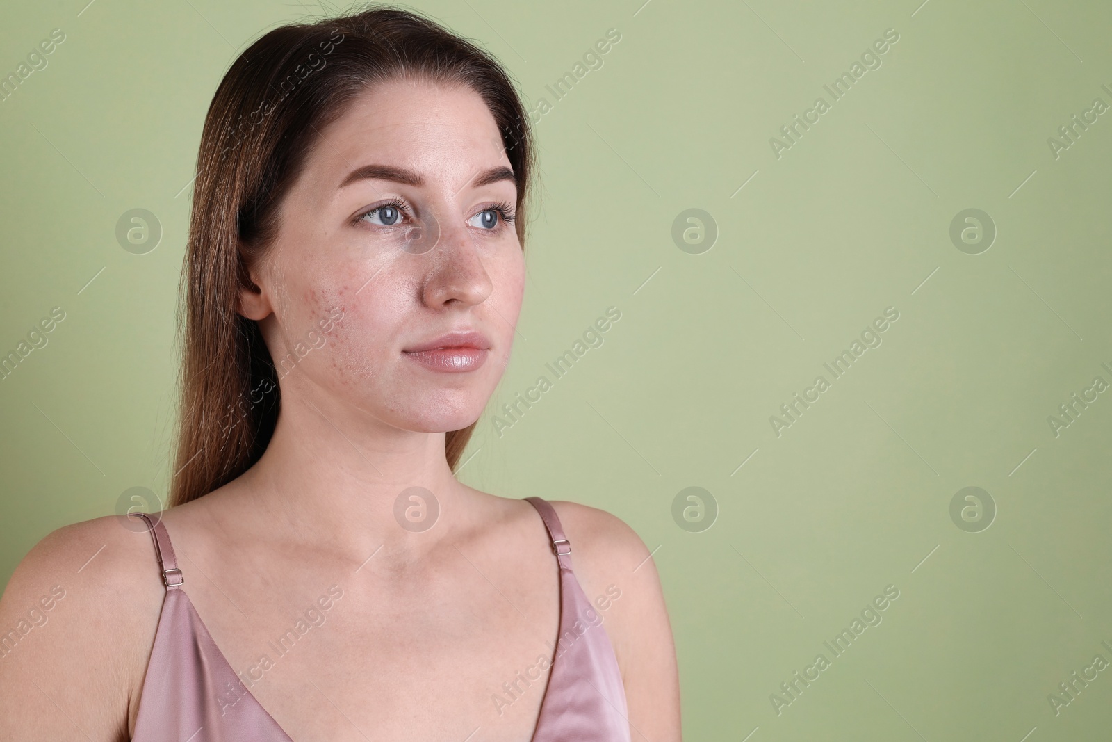 Photo of Young woman with acne problem on olive background. Space for text