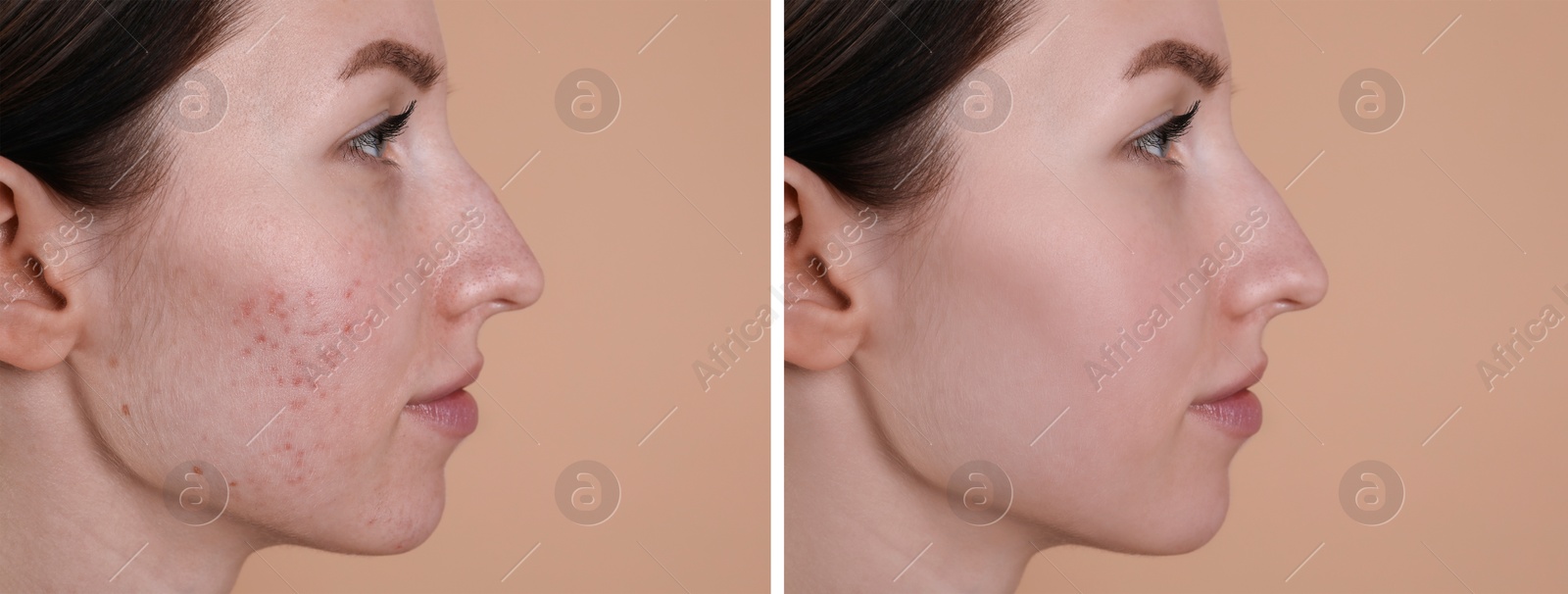 Image of Acne problem. Young woman before and after treatment on beige background, collage of photos