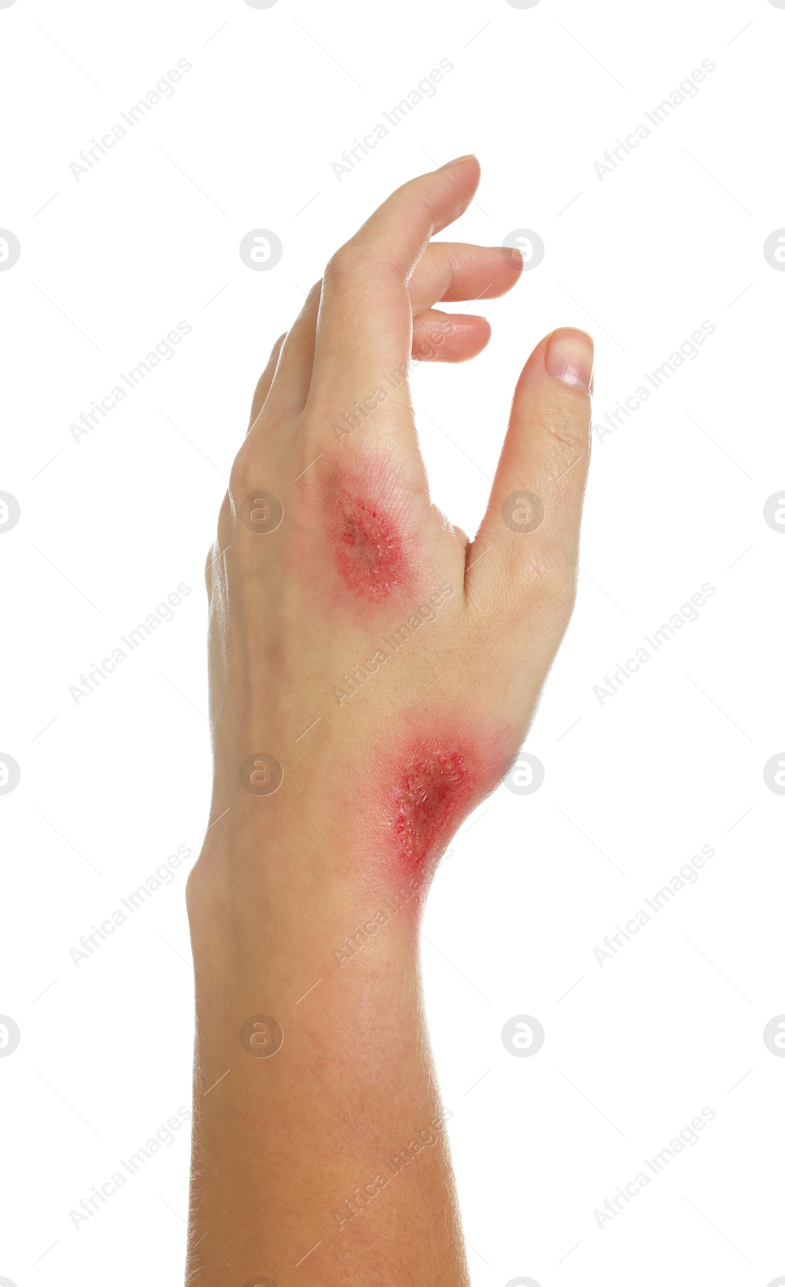 Photo of Woman with burned hand on white background, closeup