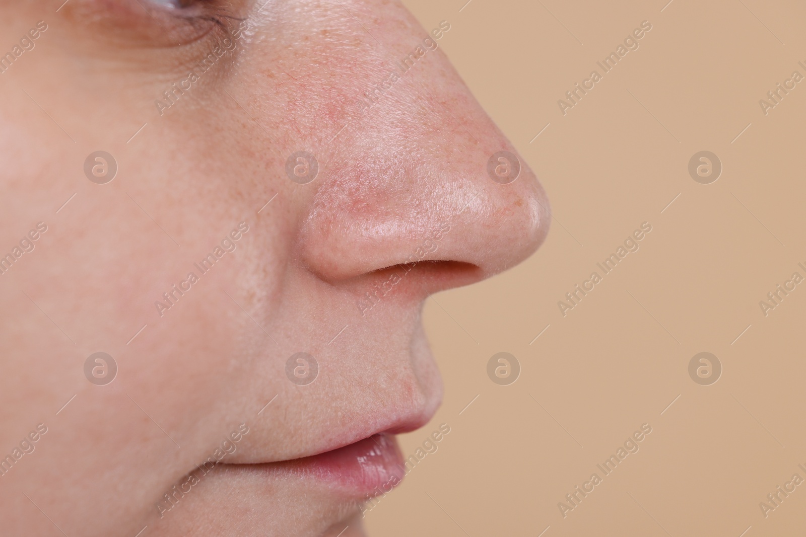 Photo of Closeup view of woman with blackheads on her nose against beige background, space for text