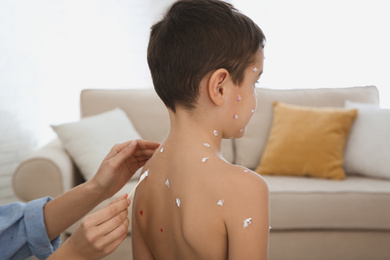 Photo of Woman applying cream onto skin of little boy with chickenpox at home