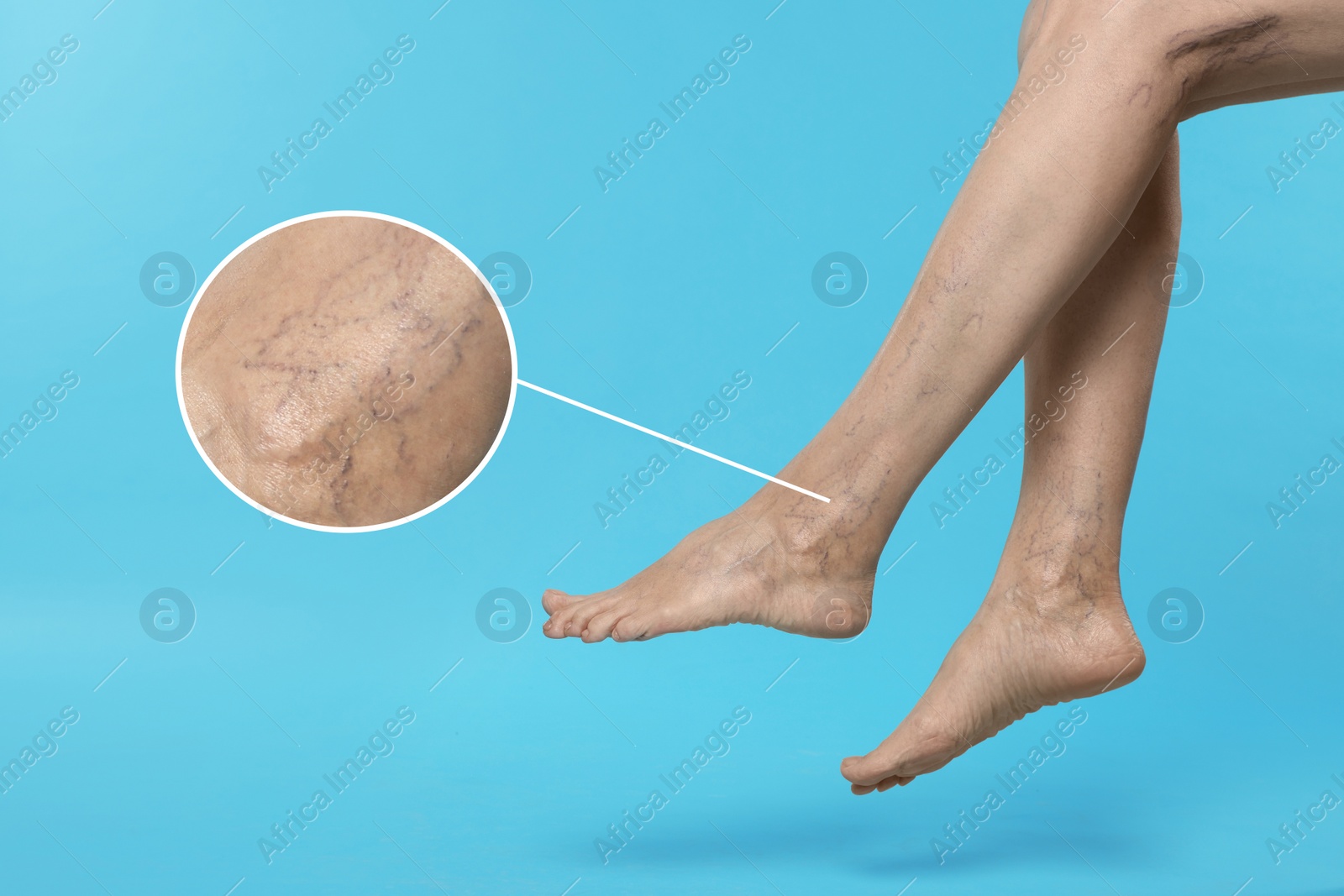 Image of Woman suffering from varicose veins on light blue background, closeup. Magnified skin surface showing affected area