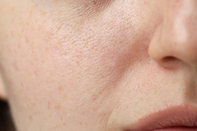 Macro view of woman with dry skin