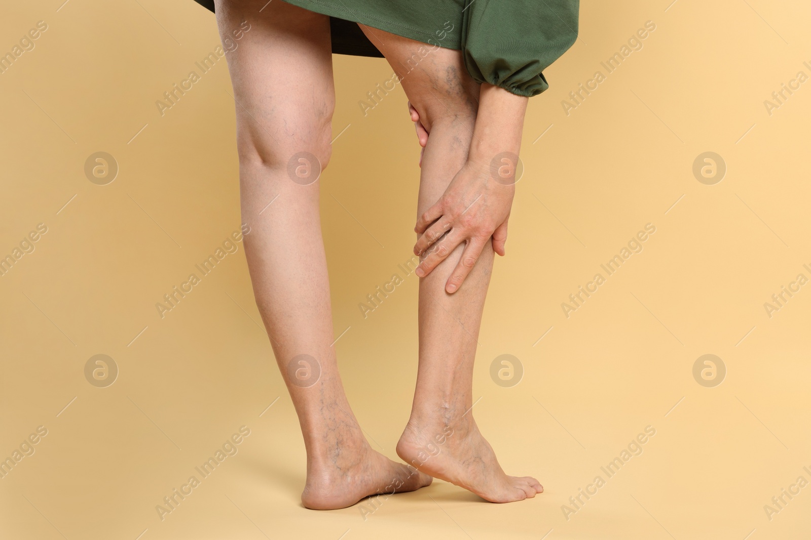 Photo of Closeup view of woman suffering from varicose veins on yellow background