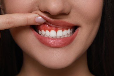 Woman showing inflamed gum, closeup. Oral cavity health