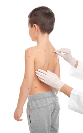 Photo of Doctor applying cream onto skin of little boy with chickenpox on white background. Varicella zoster virus
