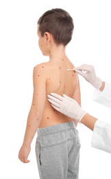 Doctor applying cream onto skin of little boy with chickenpox on white background. Varicella zoster virus