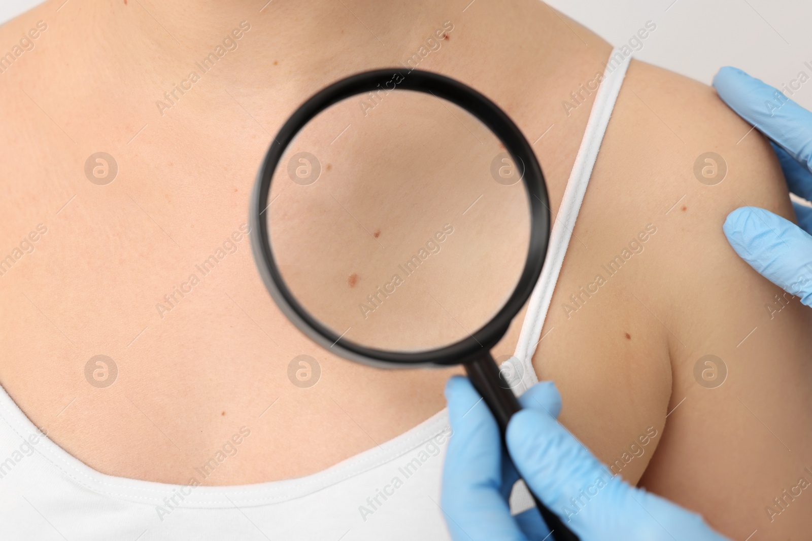 Photo of Dermatologist examining patient's birthmark with magnifying glass on beige background, closeup