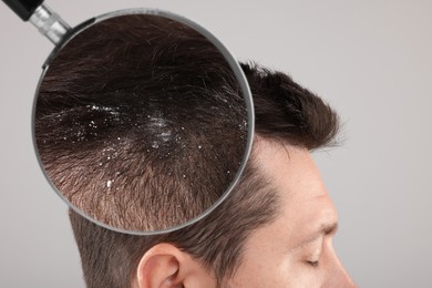 Man suffering from dandruff on light grey background, closeup. View through magnifying glass on hair with flakes