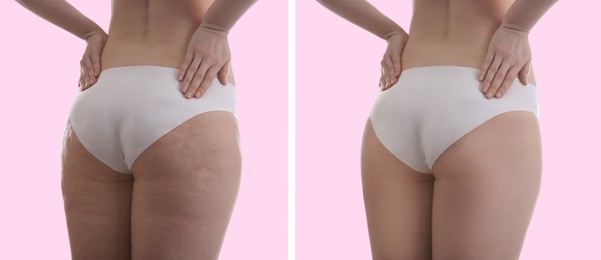 Image of Collage with photos of woman before and after anti cellulite treatment on pink background, 