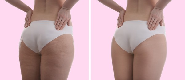 Collage with photos of woman before and after anti cellulite treatment on pink background, 