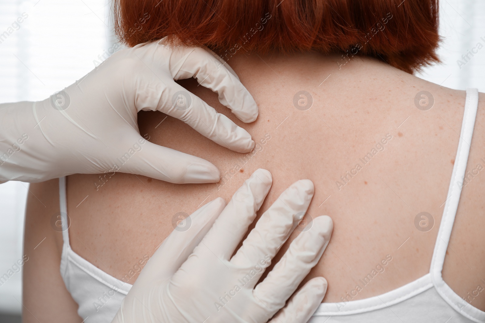 Photo of Dermatologist examining patient's birthmark in clinic, closeup view