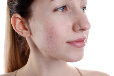 Young woman with acne problem on white background, closeup