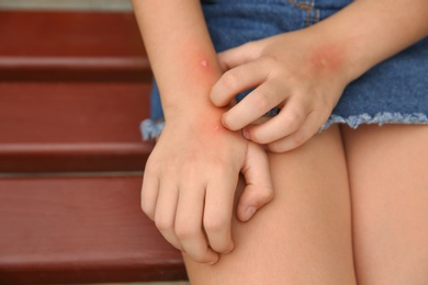 Photo of Girl scratching hand with insect bites outdoors, closeup