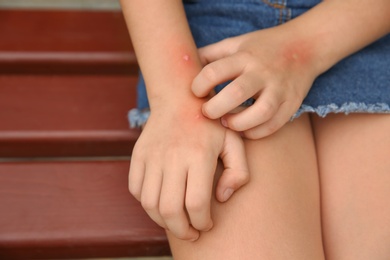 Girl scratching hand with insect bites outdoors, closeup