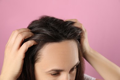 Mature woman suffering from baldness on pink background, closeup