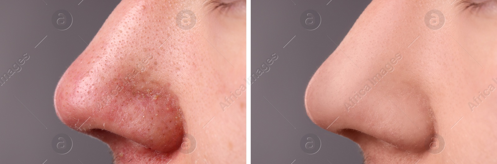 Image of Before and after acne treatment. Photos of man on grey background, closeup. Collage showing affected and healthy skin