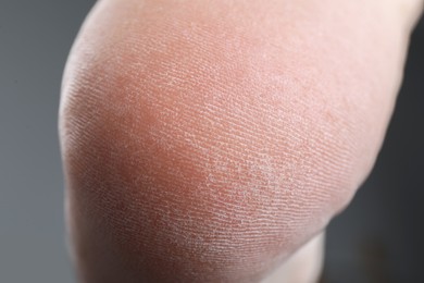 Photo of Woman with dry skin on foot, closeup