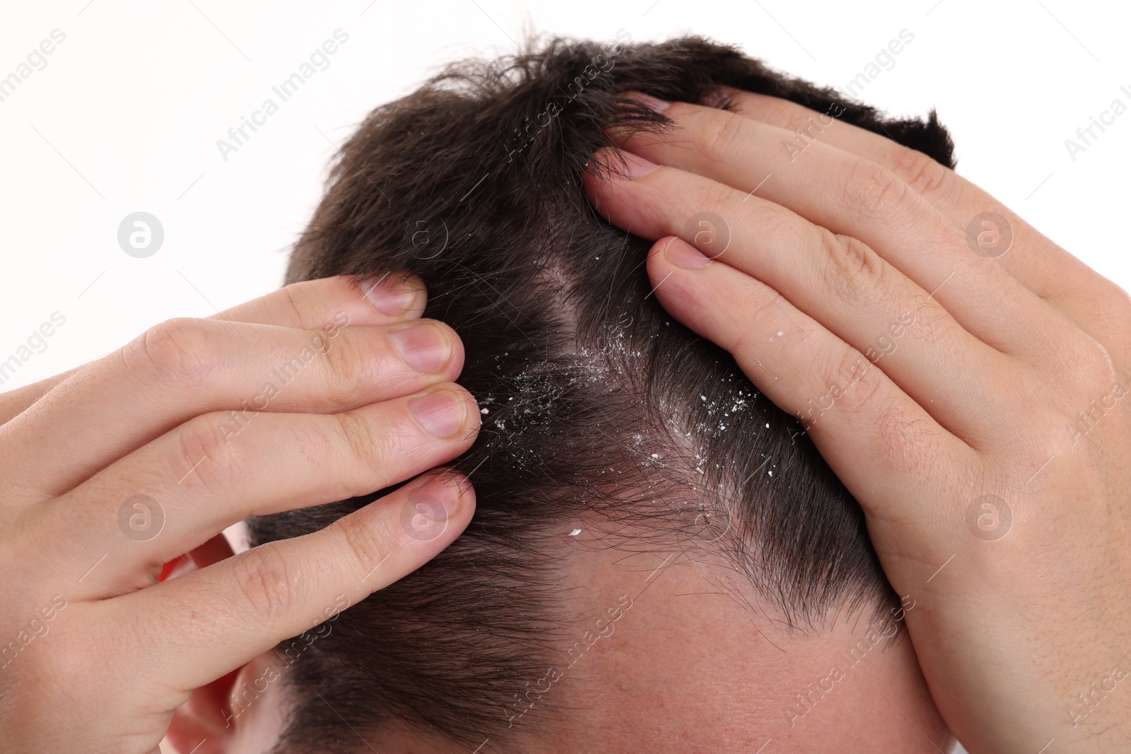 Photo of Man with dandruff in his dark hair on white background, closeup