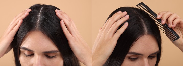 Woman showing hair before and after dandruff treatment on beige background, collage