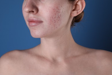 Young woman with acne problem on blue background, closeup