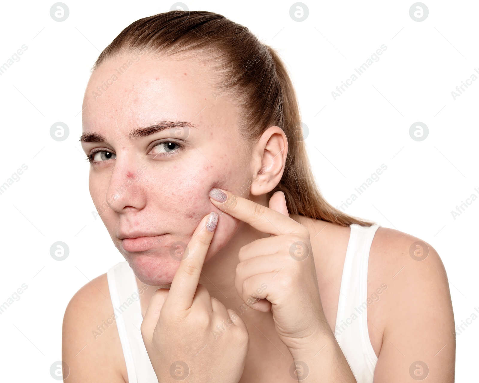 Photo of Young woman with acne problem on white background