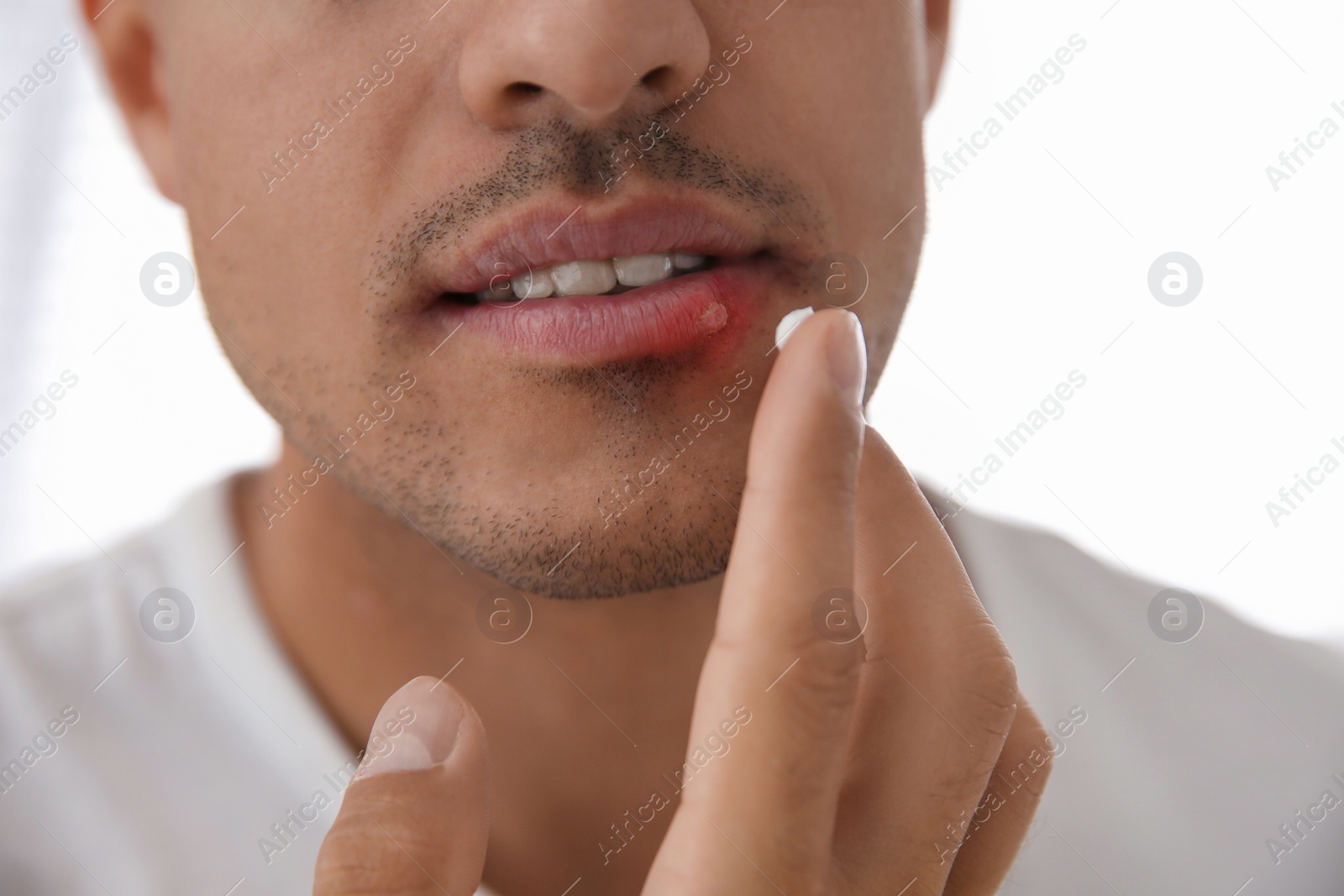 Photo of Man with herpes applying cream on lips against light background, closeup