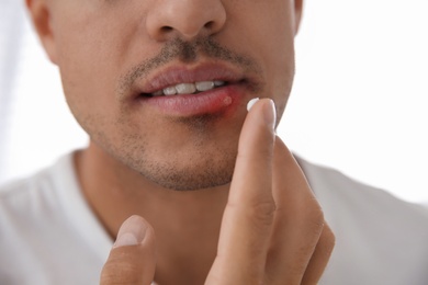 Man with herpes applying cream on lips against light background, closeup