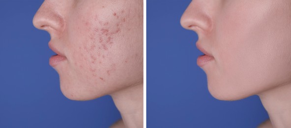 Image of Acne problem. Young woman before and after treatment on blue background, closeup. Collage of photos