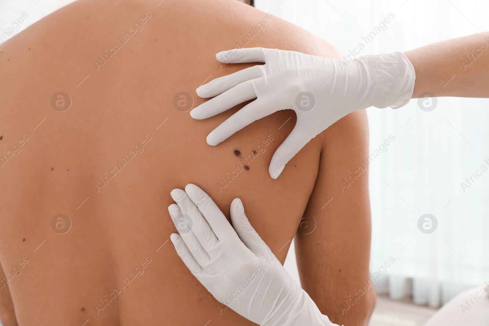 Photo of Dermatologist examining patient's birthmark in clinic, closeup