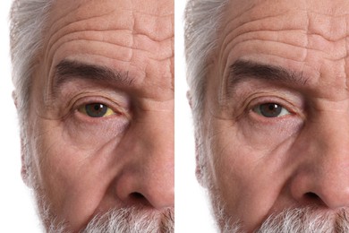 Image of Collage with photos of senior man before and after hepatitis treatment, focus on eyes