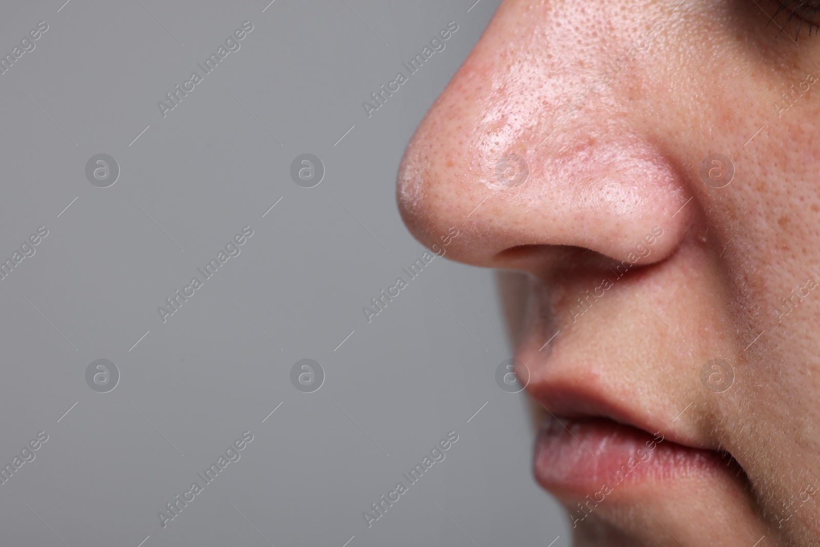 Photo of Closeup view of woman with unhealthy skin on grey background, space for text
