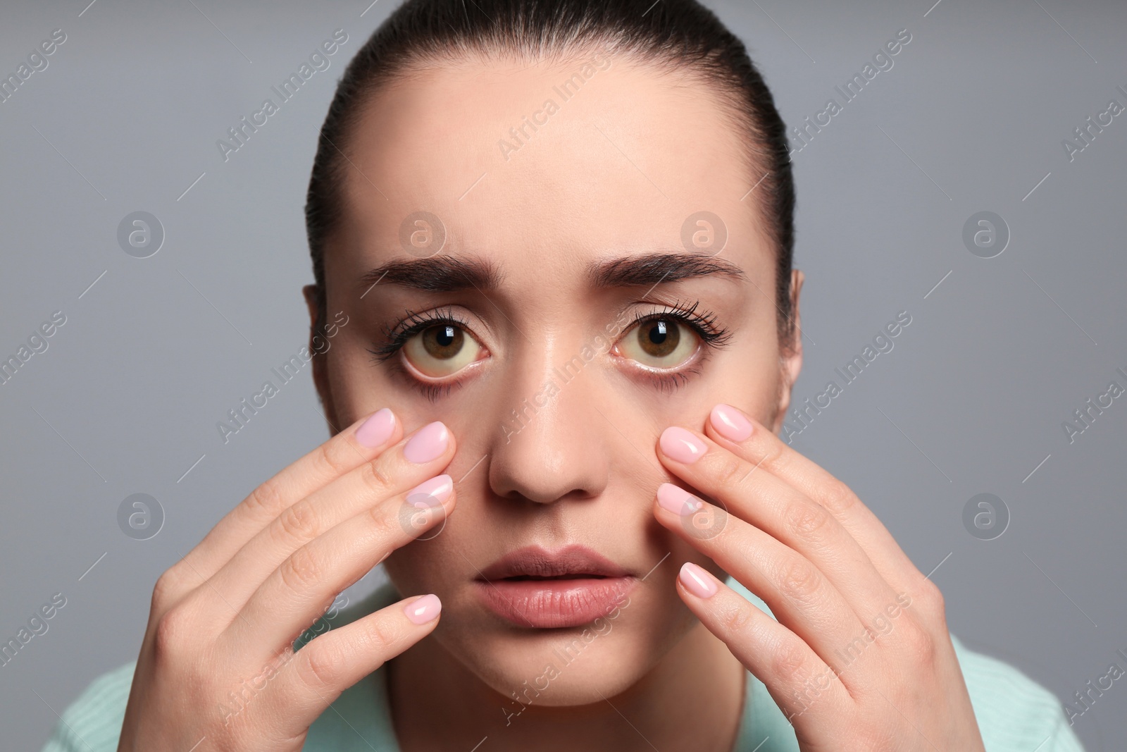 Photo of Woman checking her health condition on grey background. Yellow eyes as symptom of problems with liver