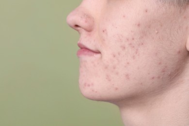 Photo of Young man with acne problem on olive background, closeup. Space for text
