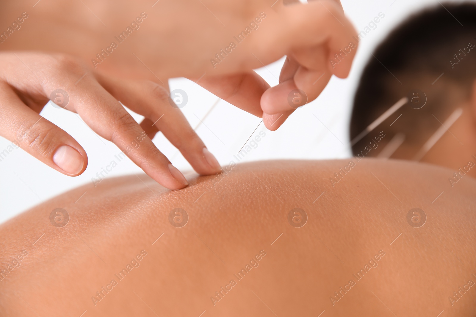 Photo of Young man undergoing acupuncture treatment in salon, closeup