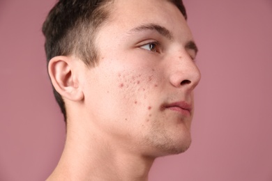 Young man with acne problem on color background