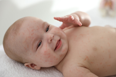 Image of Little child with red rash on bed. Baby allergies