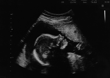 Photo of Ultrasound photo of unborn baby in mother's womb, closeup view