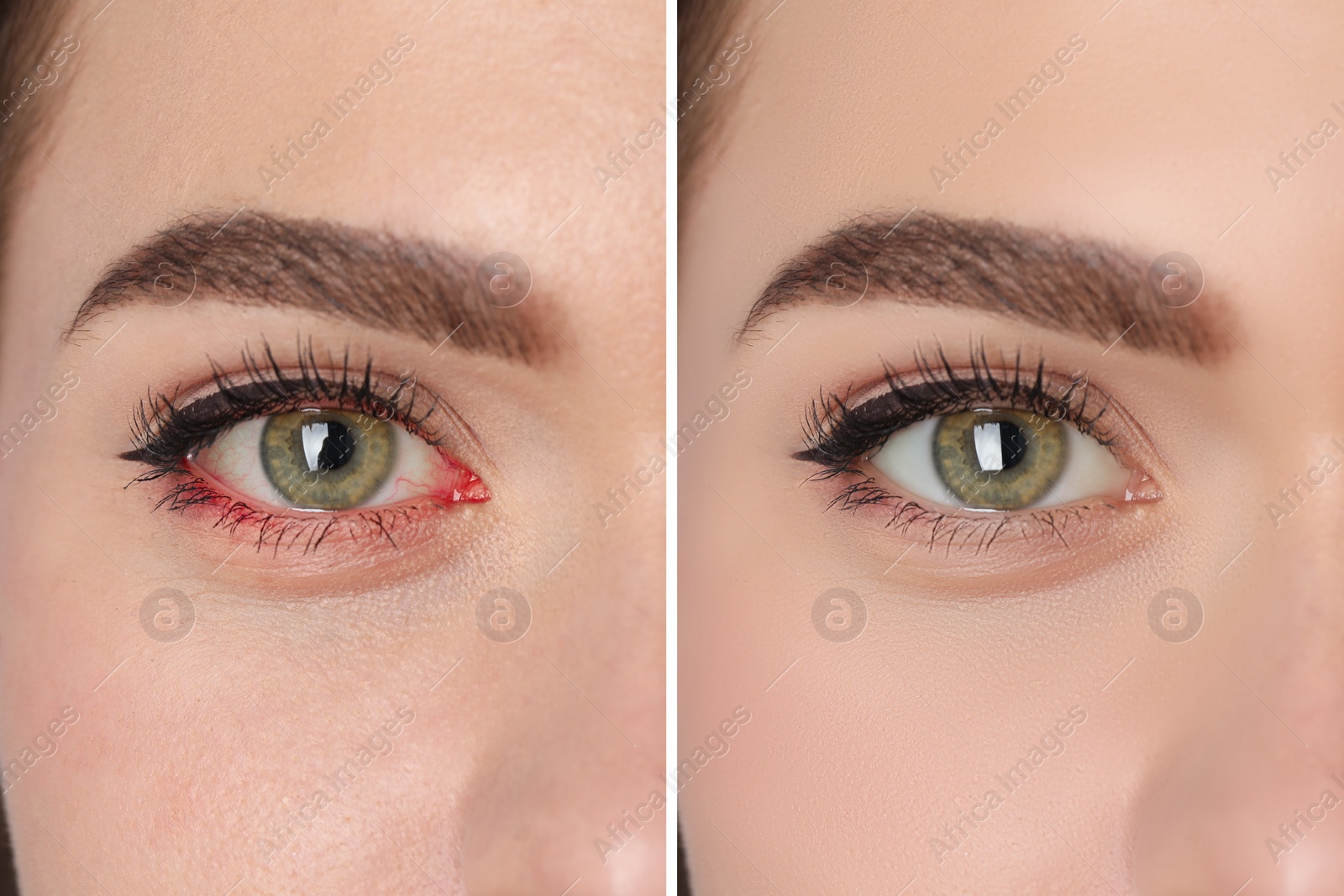 Image of Collage with photos of woman before and after conjunctivitis treatment, closeup of infected and healthy eye