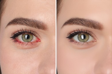 Image of Collage with photos of woman before and after conjunctivitis treatment, closeup of infected and healthy eye
