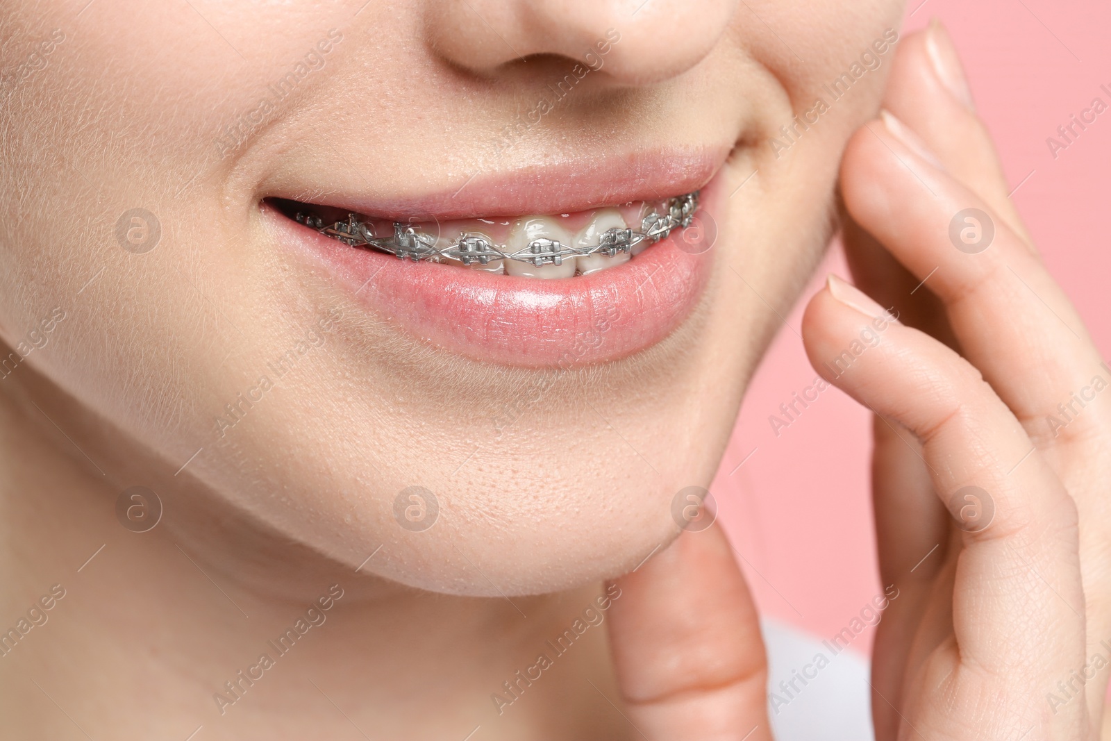 Photo of Smiling woman with dental braces on pink background, closeup