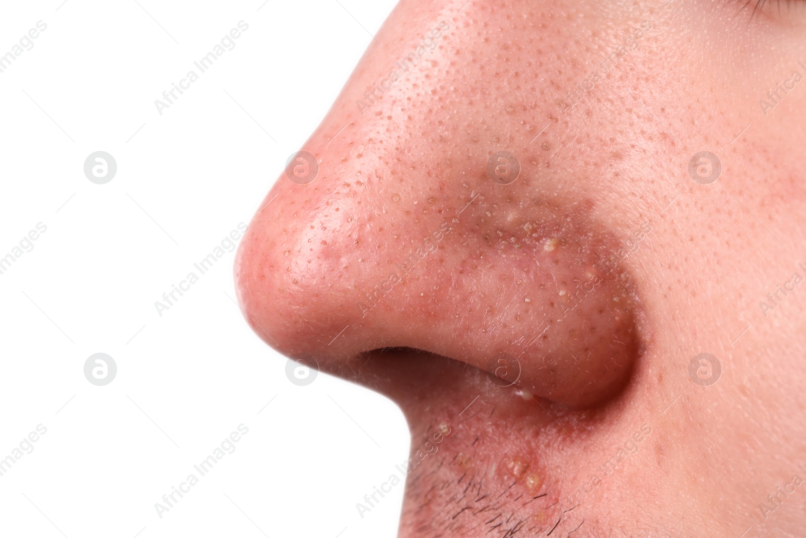 Photo of Young man with acne problem on grey background, closeup view of nose