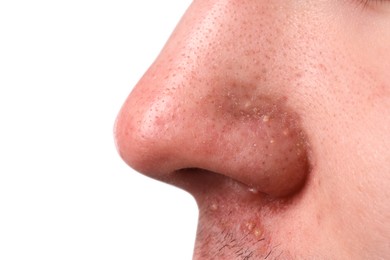 Young man with acne problem on grey background, closeup view of nose