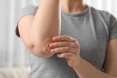 Photo of Woman applying ointment onto her elbow indoors, closeup