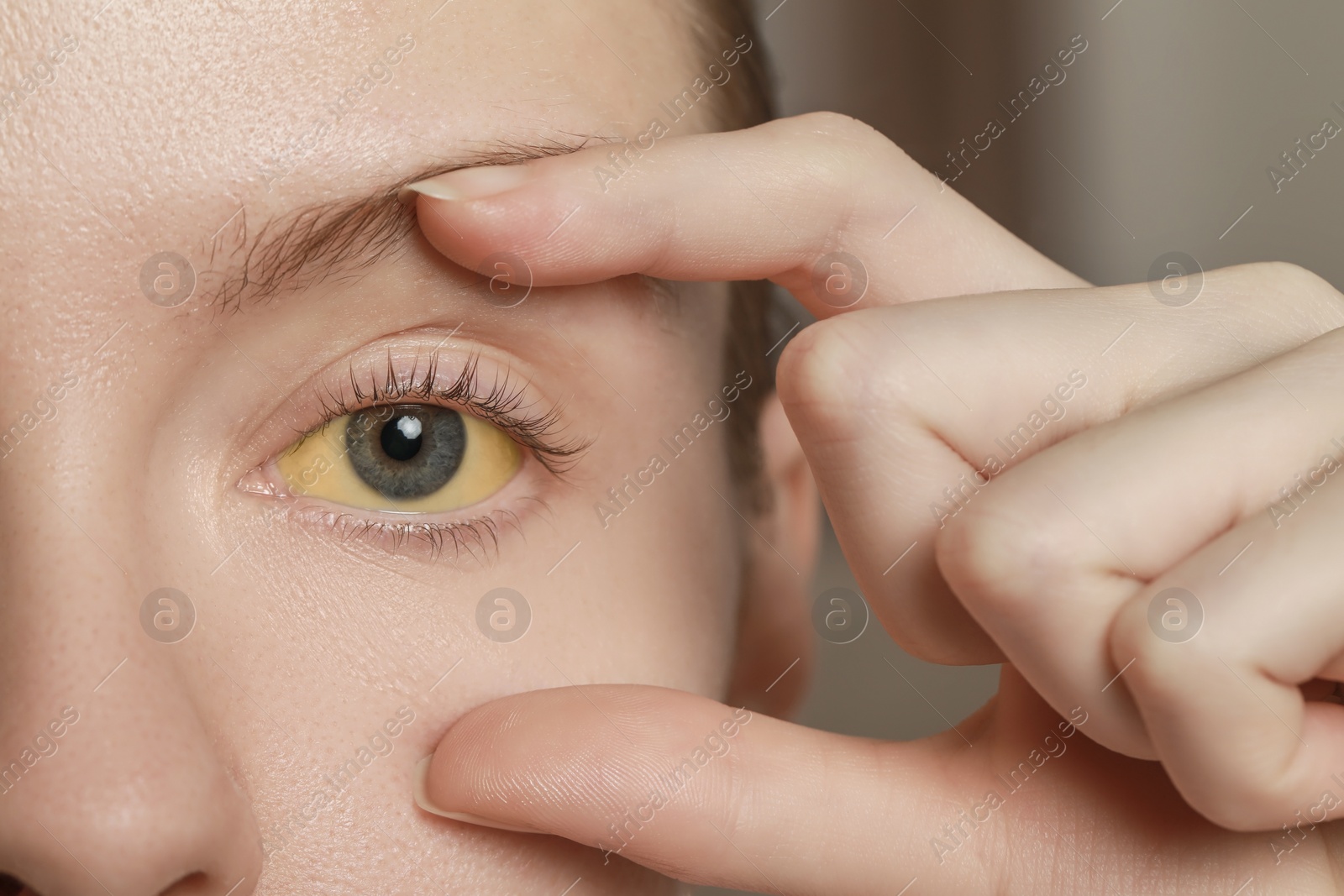 Photo of Woman with yellow eyes on blurred background, closeup. Symptom of hepatitis