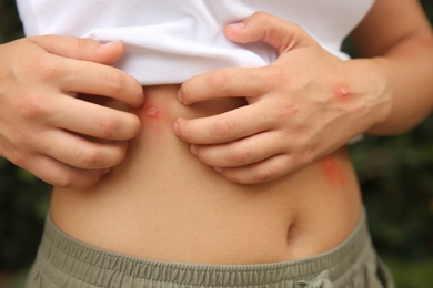 Photo of Woman scratching abdomen with insect bite outdoors, closeup