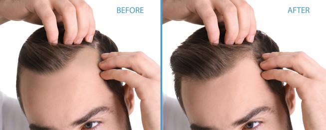 Image of Closeup view of man before and after hair loss treatment on white background, collage. Banner design