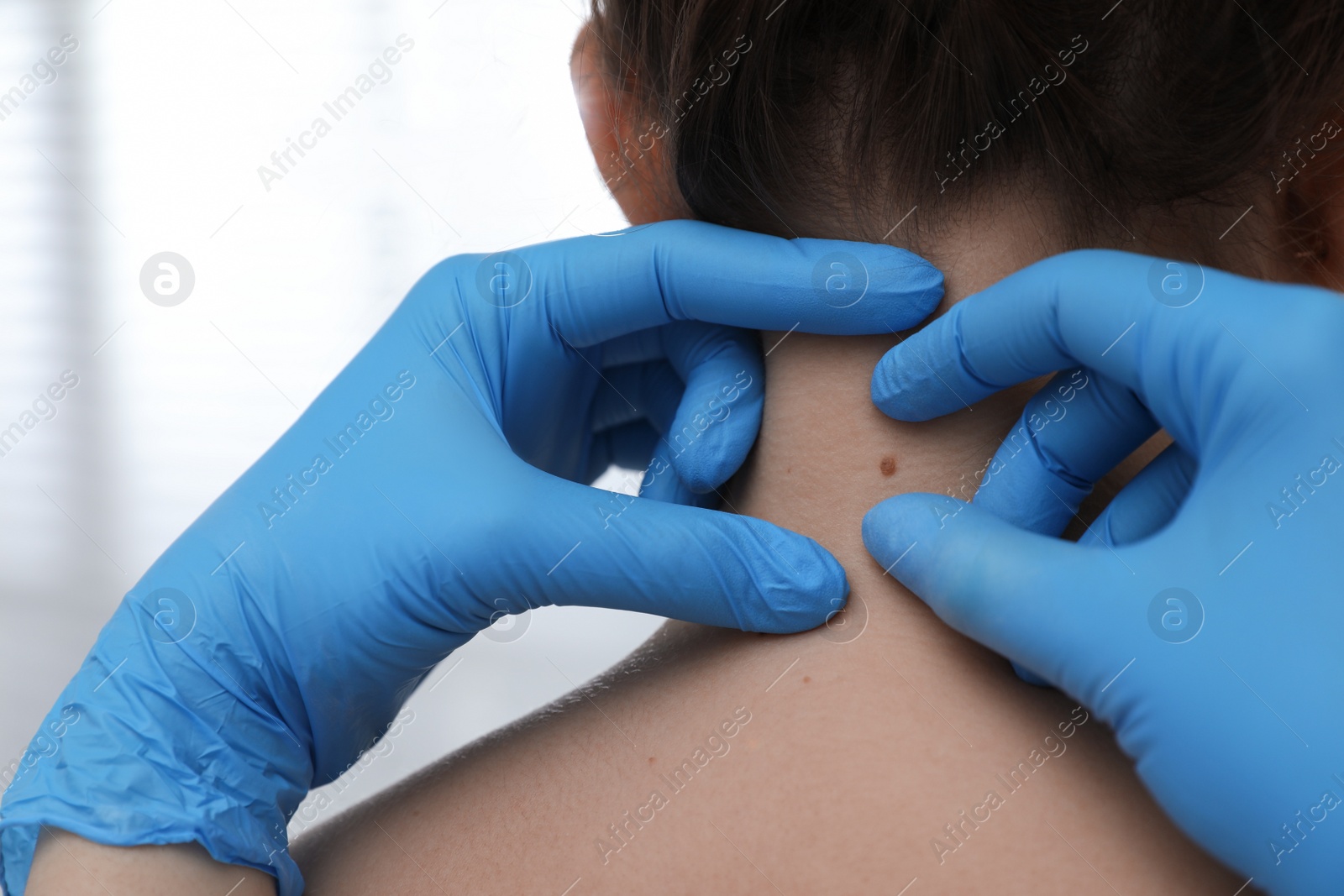 Photo of Dermatologist examining patient's birthmark in clinic, closeup view