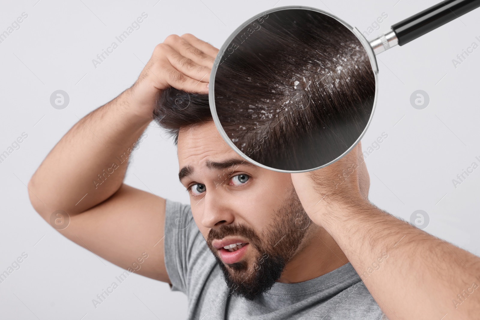 Image of Man suffering from dandruff on light grey background. View through magnifying glass on hair with flakes