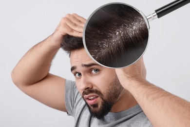 Man suffering from dandruff on light grey background. View through magnifying glass on hair with flakes